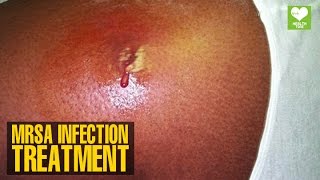 MRSA Infection Treatment  Health Tips  Education [upl. by Inalan]