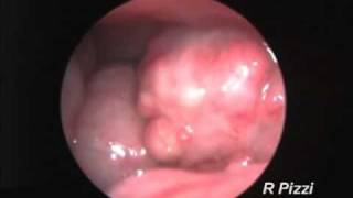 Endoscopy of a chicken with salpingitismp4 [upl. by Tadd]