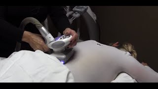 Dr Milan Shah explains what Endermologie is and what it does [upl. by Etac1]