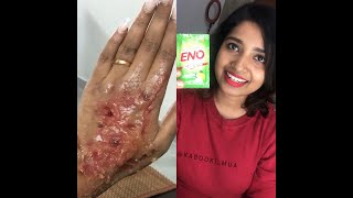 DIY easy SFXProsthetics makeup  Tricks to create a fake Burn Wound [upl. by Airliah423]