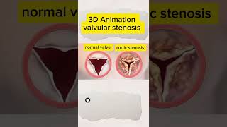 Heart Valve Trouble 🤔 Shortness of Breath Chest Pain 💔 shorts [upl. by Anthe]