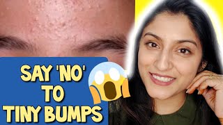 7 Days Challenge 😲 Treat TINY BUMPS on FOREHEADSFACE NATURALLY  100 Works Home Remedy [upl. by Lehsreh]