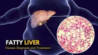 Fatty Liver Causes Signs and Symptoms Diagnosis and Treatment [upl. by Nylinej]