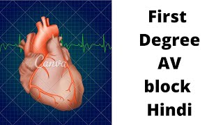 ECG test  ECG kaise karte hai  First degree atrioventricular blockAV block Heart block in hindi [upl. by Akimahc175]