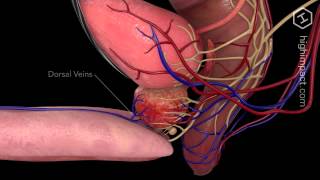 Open Prostatectomy [upl. by Ushijima]