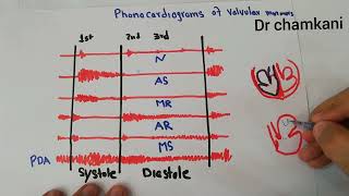 CVS 233  Phonocardiograms of valvular murmurs  Aortic and mitral [upl. by Evelc]