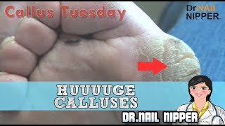 Absolute Monster Callus HUUUUGE Foot Calluses 26  Callus Tuesday Huge Callus [upl. by Emma]