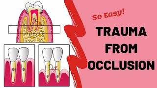 Trauma From Occlusion TFO  PERIODONTOLOGY [upl. by Joyce]