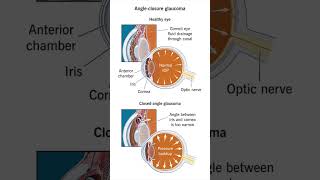 Symptoms of AngleClosure Glaucoma [upl. by Ane779]