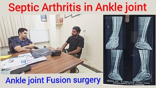 SEPTIC ARTHRITIS IN ANKLE JOINT FUSION SURGERY PAIN in Ankle arthritis [upl. by Airamat588]