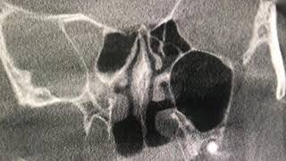 Deviated Nasal Septum explained with Cone Beam CT scan [upl. by Mungo521]