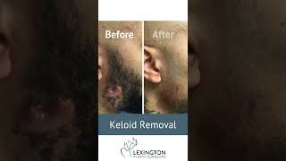 Keloid Removal Before and After [upl. by Hannover]