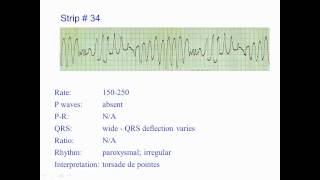 ECG Exercise 34 [upl. by Aisnetroh]