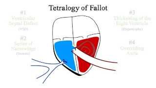 Tetralogy of Fallot [upl. by Nnaegroeg]