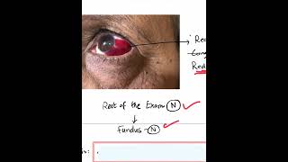 SubConjunctival Hemorrhage SCH  Case Discussion In A Minute Shorts [upl. by Mis]