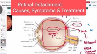 Retinal Detachment Opthalmology 17  First Aid USMLE Step 1 in Hindi [upl. by Christmann]