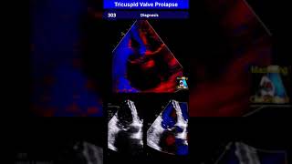 Tricuspid Valve Prolapse TVP [upl. by Eeryk]