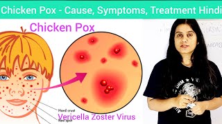 Chicken Pox  Cause Symptoms Diagnosis Treatment Hindi  Vericella Zoster VirusChicken Pox Hindi [upl. by Aicital]