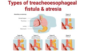 Types of treacheoesophageal fistula amp Atresia ll TEF ll pediatrics ll medical education [upl. by Airbmat]