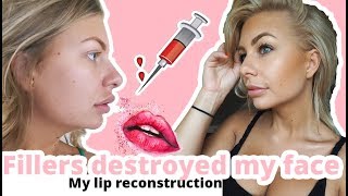 FILLERS DESTROYED MY FACE  My lip reconstruction  Reducing my double chin [upl. by Celene]