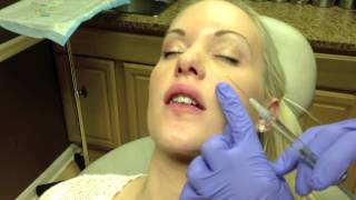 Botox amp Juvederm Lip Injection in Virginia by Dr Naderi DC VA MD [upl. by Suhploda]