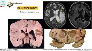 Porencephaly versus Schizencephaly 12 [upl. by Higinbotham]