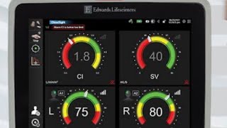 INTERMITTENT THERMODILUTION CARDIAC OUTPUT MONITORING ON HEMOSPHERE MONITOR [upl. by Gregor]