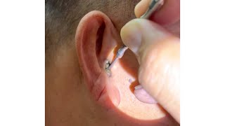 Removing Grandpas 70 Year Old Hard Earwax [upl. by Gipps]