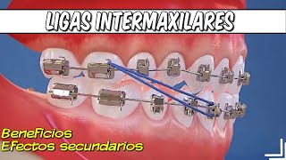 Elásticos Intermaxilares ¿Qué son ¿Para qué Sirven  Beneficios de las Ligas Intermaxilares [upl. by Nnyleuqaj]