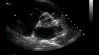 Transthoracic ECHO Parasternal Short Axis at the Aortic Valve [upl. by Iormina]