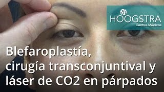 Blefaroplastía cirugía transconjuntival y láser de CO2 en párpados 16127 [upl. by Stralka]