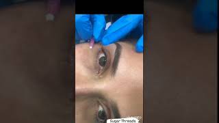 PDO Inch Thread for Under Eye Rejuvenation [upl. by Tisdale620]