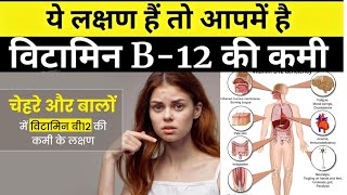 vitamin B12 Deficiency Symptoms Causes Treatment in Hindi  विटामिन बी के कमी के कारण और लक्षण इलाज [upl. by Taddeo]