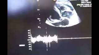 Echo cardiography of cardiac tamponade [upl. by Elinor]