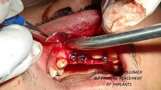 ENUCLEATION  IMPLANTS GBR  GTR [upl. by Ng]