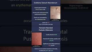 Erythema Toxicum Neonatorum vs Transient Neonatal Pustular Melanosis [upl. by Doolittle]