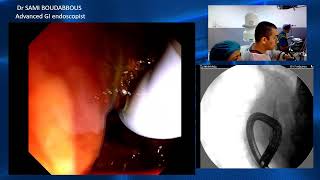 ercp for sems obstruction [upl. by Miguelita158]