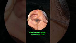 Charcoalblack earwax clogs the ear canal earwax earwaxremoval satisfying asmr [upl. by Anahoj112]