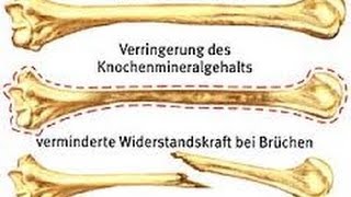 Osteoporose Knochenschwund und die richtige Ernährung [upl. by Brieta]