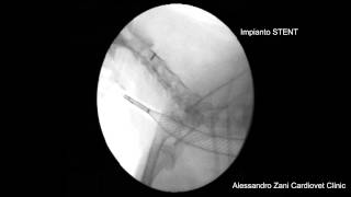 Tracheal Stent Alessandro Zani Cardiovet Clinic Livorno [upl. by Anauj431]