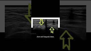 ultrasound Guided Interventions Cases Trochanteric Bursitis Injection [upl. by Bucher238]