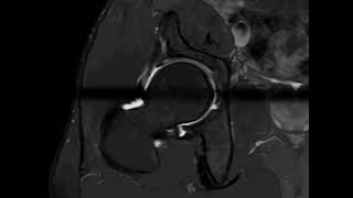 Mri hip arthrography radial sequence [upl. by Hui985]