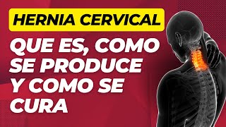 HERNIA CERVICAL C5C6 SINTOMAS TRATAMIENTO Y EJERCICIO ✅ [upl. by Collin]