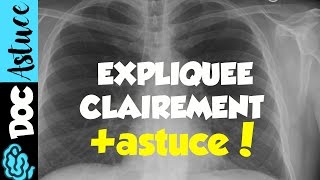 🔴6 APPRENDRE LE SYNDROME ALVEOLAIRE EN 5MIN  partie 2  DR ASTUCE [upl. by Irakuy]