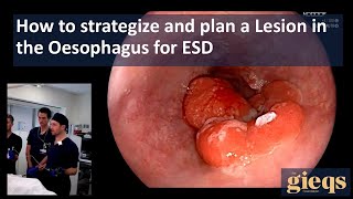 How to strategize and plan a Lesion in the Oesophagus for ESD [upl. by Schweiker]