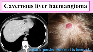 cavernous liver haemangioma [upl. by Kara]