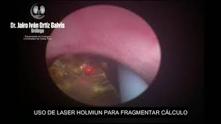 LITOTRICIA LASER EN CALCULO URETERAL DERECHO [upl. by Viridis]