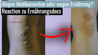 Psoriasis gezielt mit Ernährung lindern oder doch Medikamente  Reaction [upl. by Labanna72]