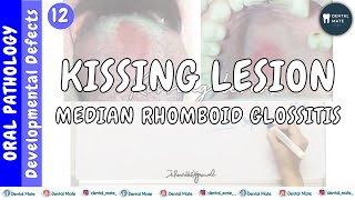 Median rhomboid glossitis  Kissing lesion  Central papillary atrophy  Dr Paridhi Agrawal [upl. by Cary344]