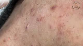 Satisfying Relaxing with Vien Tham My DrAZI vienthammydrazi0158 acne pimples blackheads [upl. by Notsreik253]